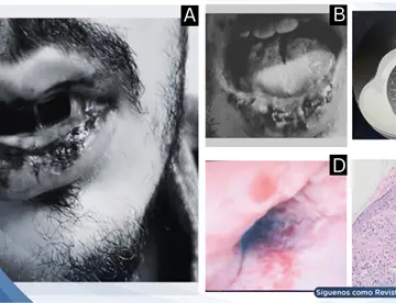 Síndrome de Fuchs inducido por levofloxacina se ocultó tras mucositis severa sin lesiones cutáneas