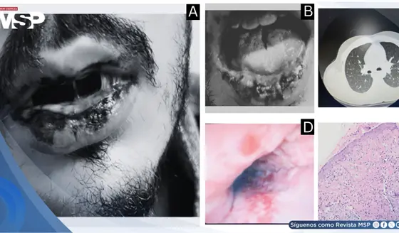 Síndrome de Fuchs inducido por levofloxacina se ocultó tras mucositis severa sin lesiones cutáneas