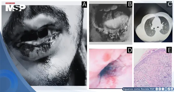 Síndrome de Fuchs inducido por levofloxacina se ocultó tras mucositis severa sin lesiones cutáneas