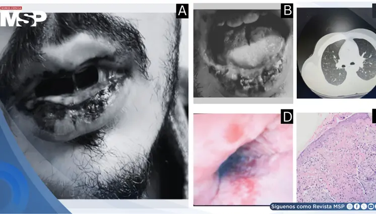 Síndrome de Fuchs inducido por levofloxacina se ocultó tras mucositis severa sin lesiones cutáneas Síndrome de Fuchs inducido por levofloxacina se ocultó tras mucositis severa sin lesiones cutáneas
