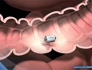 Crean píldoras inteligentes con bacterias para detectar enfermedades intestinales sin colonoscopia