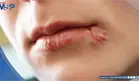 Herpes labial: ¿Qué activa el virus y cuáles son las claves para controlar los brotes?