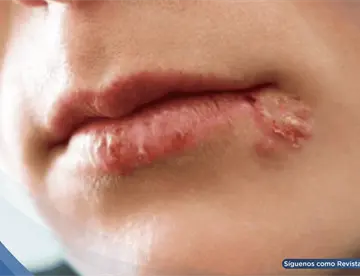 Herpes labial: ¿Qué activa el virus y cuáles son las claves para controlar los brotes?