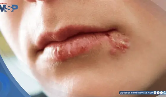 Herpes labial: ¿Qué activa el virus y cuáles son las claves para controlar los brotes?