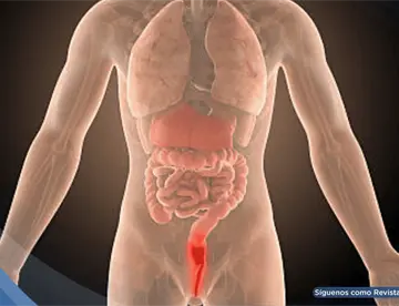 Dolor rectal, sangrado y urgencia para evacuar: síntomas que alertan sobre una proctitis 