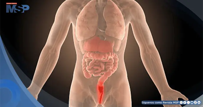 Dolor rectal, sangrado y urgencia para evacuar: síntomas que alertan sobre una proctitis 