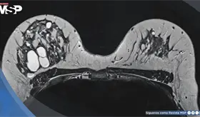 Alta densidad mamográfica podría asociarse con tumores de mama de peor pronóstico, según estudio