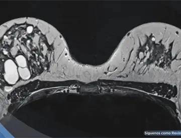 Alta densidad mamográfica podría asociarse con tumores de mama de peor pronóstico, según estudio