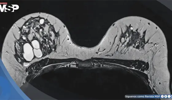 Alta densidad mamográfica podría asociarse con tumores de mama de peor pronóstico, según estudio