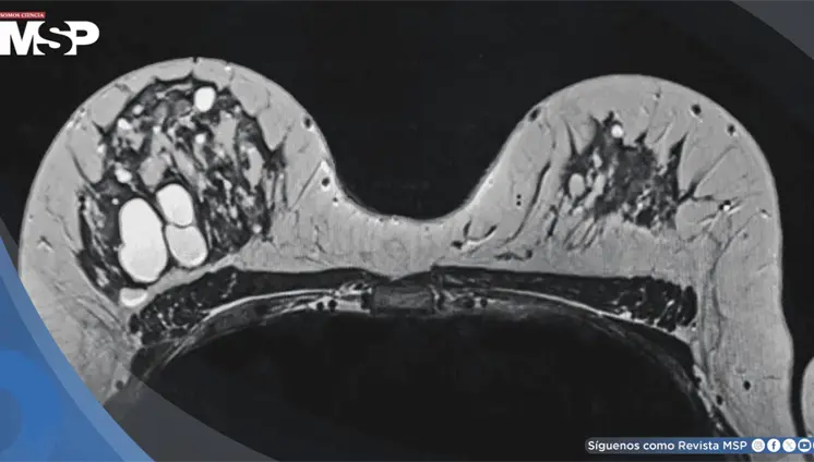 Alta densidad mamográfica podría asociarse con tumores de mama de peor pronóstico, según estudio Alta densidad mamográfica podría asociarse con tumores de mama de peor pronóstico, según estudio
