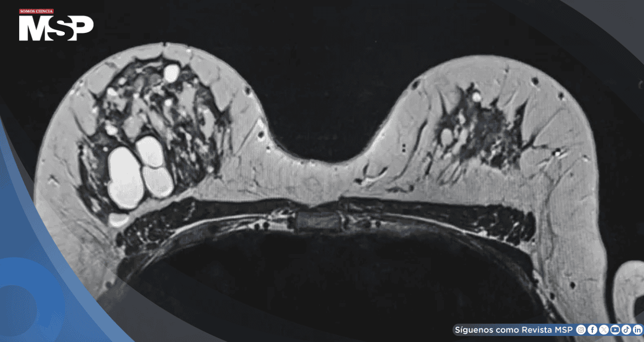 Alta densidad mamográfica podría asociarse con tumores de mama de peor pronóstico, según estudio