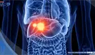 5 señales del cáncer de hígado y enfermedades que aumentan su riesgo: hepatitis, cirrosis e hígado graso
