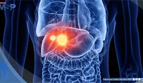 5 señales del cáncer de hígado y enfermedades que aumentan su riesgo: hepatitis, cirrosis e hígado graso