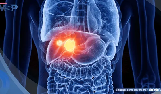 5 señales del cáncer de hígado y enfermedades que aumentan su riesgo: hepatitis, cirrosis e hígado graso