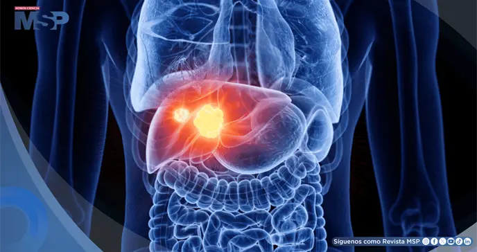 5 señales del cáncer de hígado y enfermedades que aumentan su riesgo: hepatitis, cirrosis e hígado graso