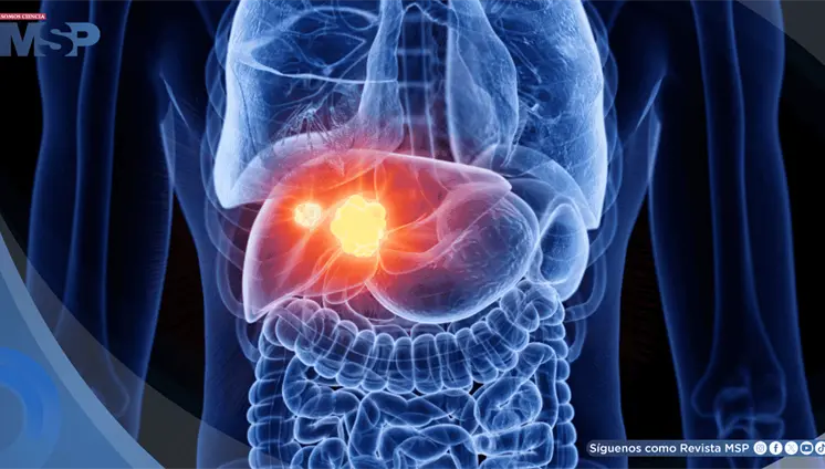 5 señales del cáncer de hígado y enfermedades que aumentan su riesgo: hepatitis, cirrosis e hígado graso 5 señales del cáncer de hígado y enfermedades que aumentan su riesgo: hepatitis, cirrosis e hígado graso