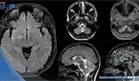 Mujer es diagnosticada con Miastenia Gravis, Neuromielitis Óptica y encefalitis tras hemorragia cerebral