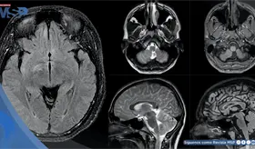 Mujer es diagnosticada con Miastenia Gravis, Neuromielitis Óptica y encefalitis tras hemorragia cerebral