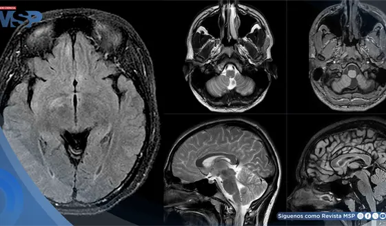 Mujer es diagnosticada con Miastenia Gravis, Neuromielitis Óptica y encefalitis tras hemorragia cerebral