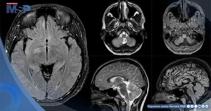 Mujer es diagnosticada con Miastenia Gravis, Neuromielitis Óptica y encefalitis tras hemorragia cerebral