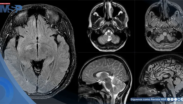 Mujer es diagnosticada con Miastenia Gravis, Neuromielitis Óptica y encefalitis tras hemorragia cerebral Mujer es diagnosticada con Miastenia Gravis, Neuromielitis Óptica y encefalitis tras hemorragia cerebral