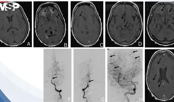 Vasculitis cerebral post-meningitis neumocócica: fiebre y neuroimagen con edema e infartos múltiples