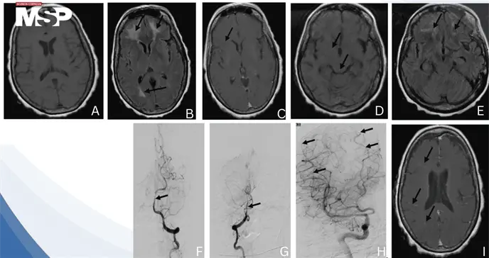 Vasculitis cerebral post-meningitis neumocócica: fiebre y neuroimagen con edema e infartos múltiples