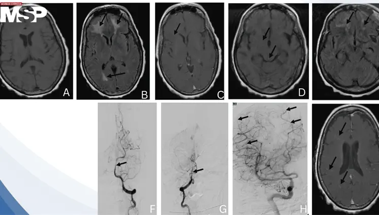 Vasculitis cerebral post-meningitis neumocócica: fiebre y neuroimagen con edema e infartos múltiples Vasculitis cerebral post-meningitis neumocócica: fiebre y neuroimagen con edema e infartos múltiples