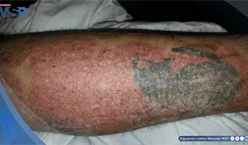 Tatuaje activa la psoriasis en un paciente en remisión