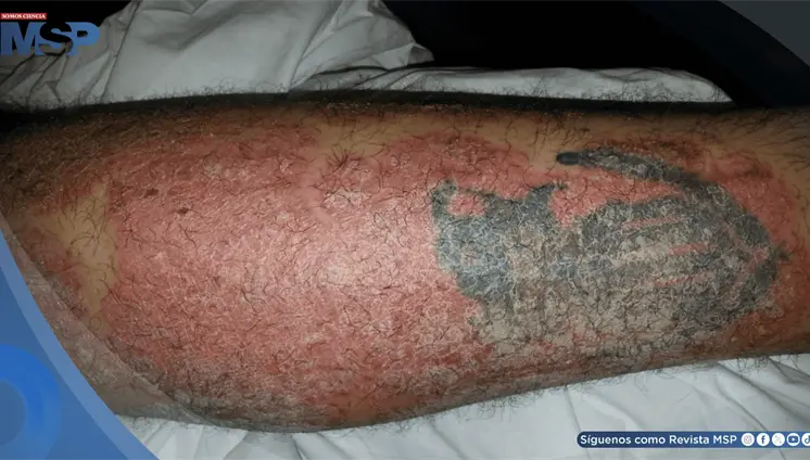 Tatuaje activa la psoriasis en un paciente en remisión