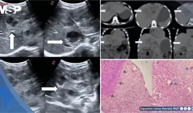 Descubren larva en el hígado de una niña de 8 años: migró desde el intestino y provocó hepatomegalia
