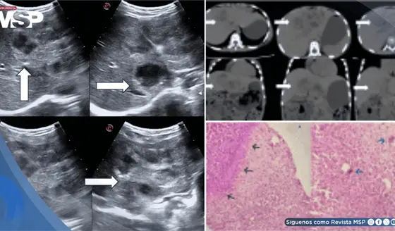 Descubren larva en el hígado de una niña de 8 años: migró desde el intestino y provocó hepatomegalia