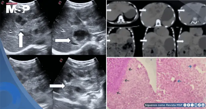 Descubren larva en el hígado de una niña de 8 años: migró desde el intestino y provocó hepatomegalia