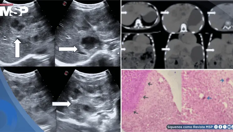 Descubren larva en el hígado de una niña de 8 años: migró desde el intestino y provocó hepatomegalia Descubren larva en el hígado de una niña de 8 años: migró desde el intestino y provocó hepatomegalia