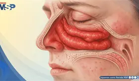 ¿Nariz tapada sin gripe? 7 causas detrás de la congestión nasal persistente y cuándo consultar