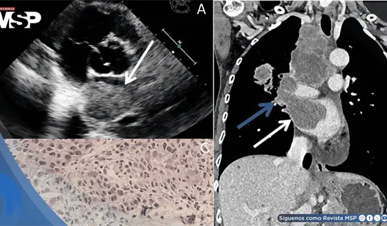 Carcinoma pulmonar avanzado detectado incidentalmente en mujer no fumadora revela metástasis cardíaca