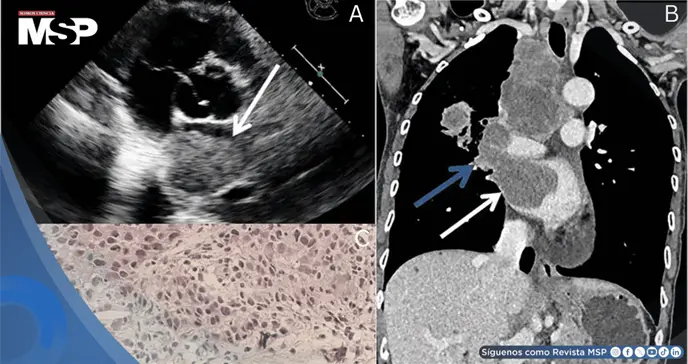 Carcinoma pulmonar avanzado detectado incidentalmente en mujer no fumadora revela metástasis cardíaca Carcinoma pulmonar avanzado detectado incidentalmente en mujer no fumadora revela metástasis cardíaca