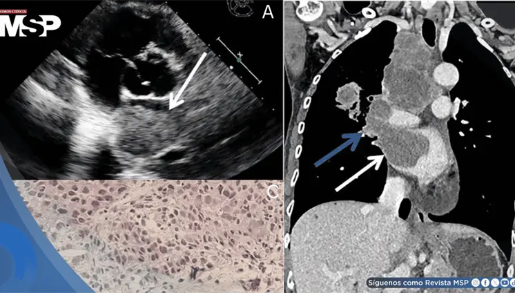 Carcinoma pulmonar avanzado detectado incidentalmente en mujer no fumadora revela metástasis cardíaca Carcinoma pulmonar avanzado detectado incidentalmente en mujer no fumadora revela metástasis cardíaca