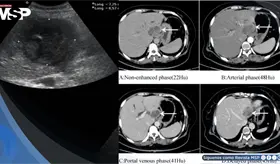Dolor lumbar confundido con hernia discal terminó siendo un absceso hepático agravado por diabetes 