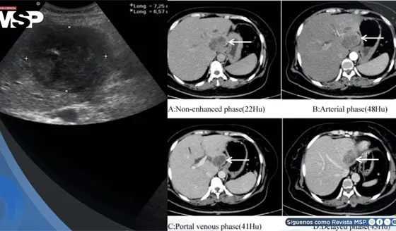 Dolor lumbar confundido con hernia discal terminó siendo un absceso hepático agravado por diabetes 