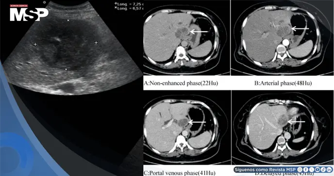 Dolor lumbar confundido con hernia discal terminó siendo un absceso hepático agravado por diabetes 