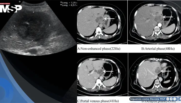 Dolor lumbar confundido con hernia discal terminó siendo un absceso hepático agravado por diabetes Dolor lumbar confundido con hernia discal terminó siendo un absceso hepático agravado por diabetes