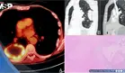Carcinoma pulmonar oculto tras dolor lumbar y ciática: Pseudoprogresión después de terapia neoadyuvante