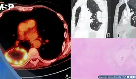 Carcinoma pulmonar oculto tras dolor lumbar y ciática: Pseudoprogresión después de terapia neoadyuvante