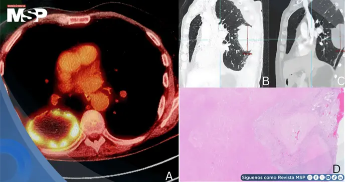 Carcinoma pulmonar oculto tras dolor lumbar y ciática: Pseudoprogresión después de terapia neoadyuvante
