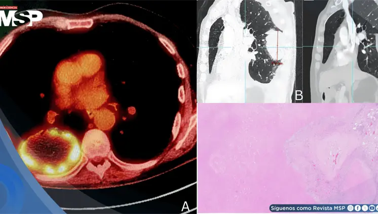 Carcinoma pulmonar oculto tras dolor lumbar y ciática: Pseudoprogresión después de terapia neoadyuvante Carcinoma pulmonar oculto tras dolor lumbar y ciática: Pseudoprogresión después de terapia neoadyuvante