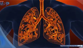 Bronquiolitis obliterante o pulmón de palomitas de maíz: Síntomas, causas y tratamiento 