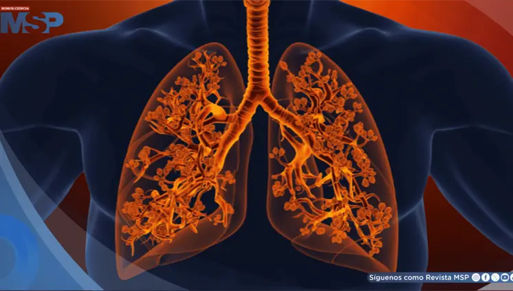 Bronquiolitis obliterante o 