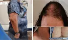 Síndrome HAIR-AN en adolescente con resistencia a insulina e hiperandrogenismo por ovario poliquístico