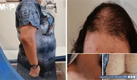 Síndrome HAIR-AN en adolescente con resistencia a insulina e hiperandrogenismo por ovario poliquístico